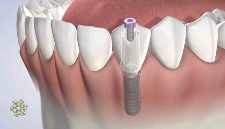 Does sucking your teeth hurt a dental implant