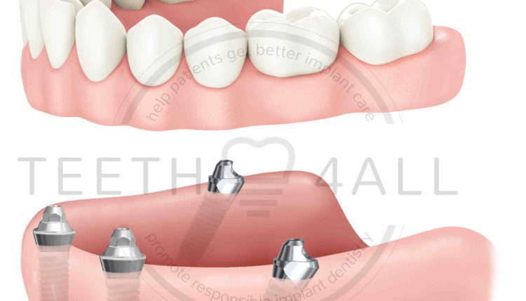 Does targets enhanced dental cover implants