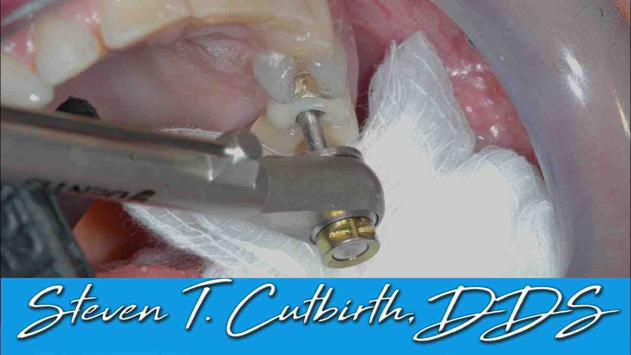 Does the abutment screw into the implant?