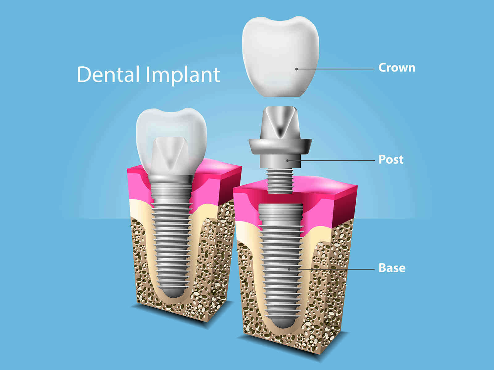 Does titanium last forever?