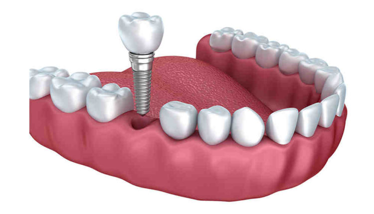 How a dental implant is done