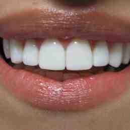 How are dental bridges anchored?