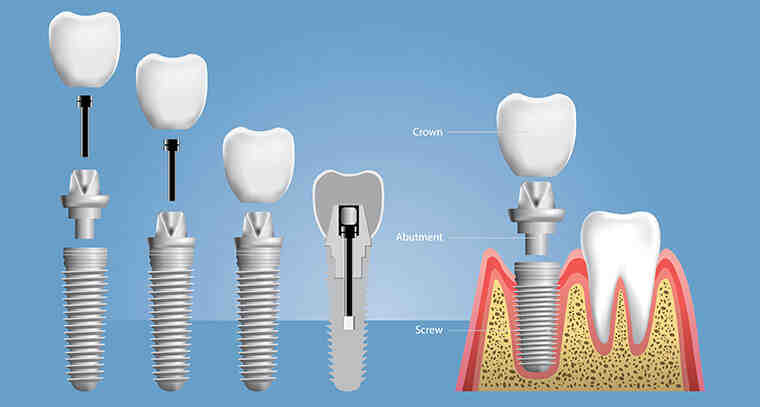 How are dental implants screwed in?