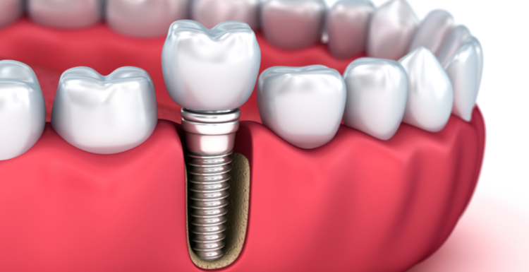 How are dental implants work