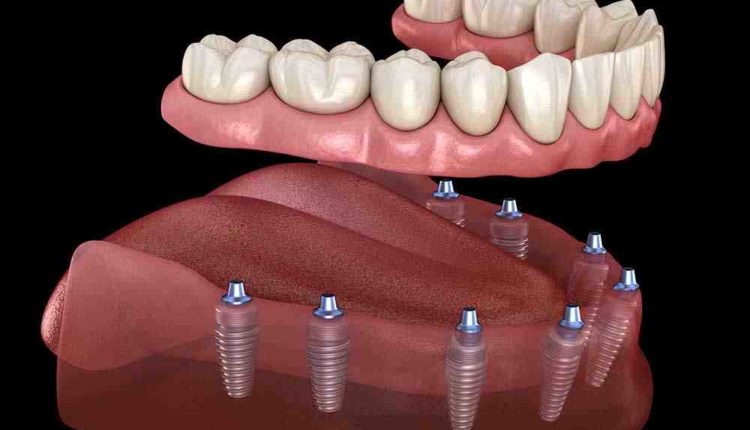 How are people afording dental implants