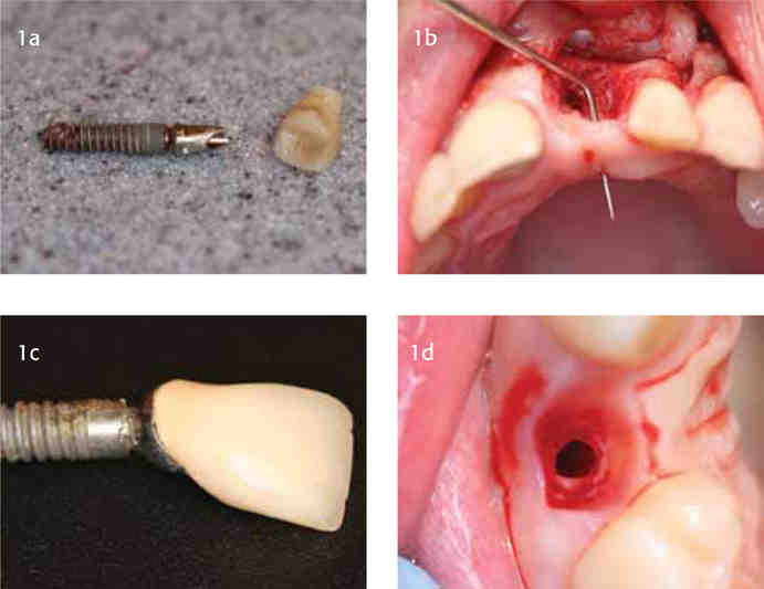 How can I fix my teeth mobility?