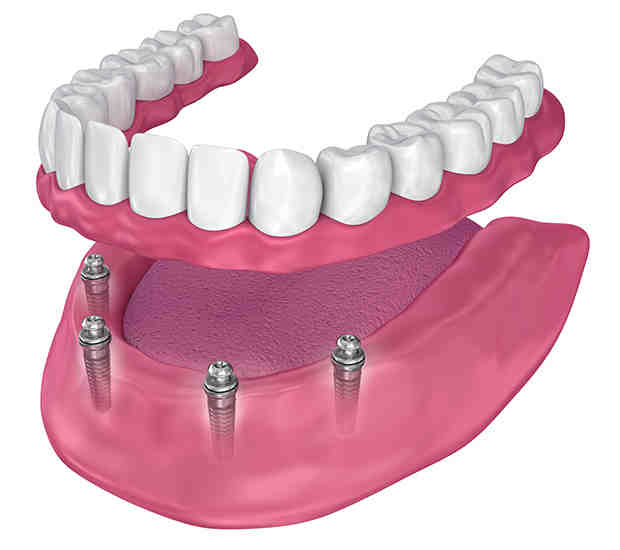 How can I hide a missing tooth?