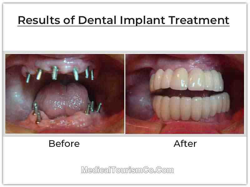 How can I make my dental implant heal faster?