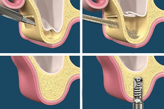 How can I make my dental implant heal faster?