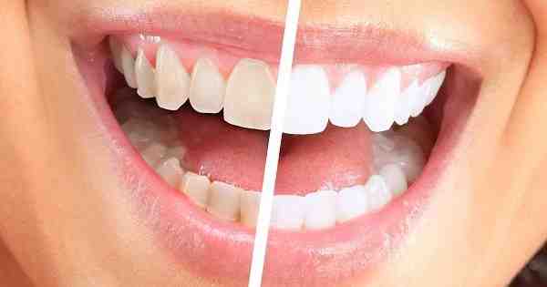 How can I whiten my teeth with implants?