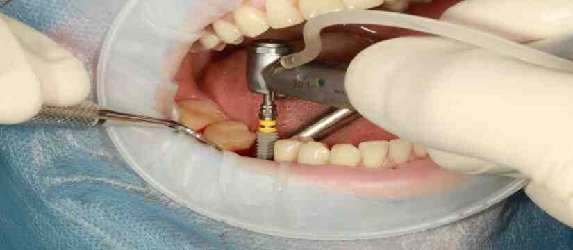 How can you avoid dental implants?