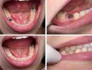 How can you tell someone has fake teeth?