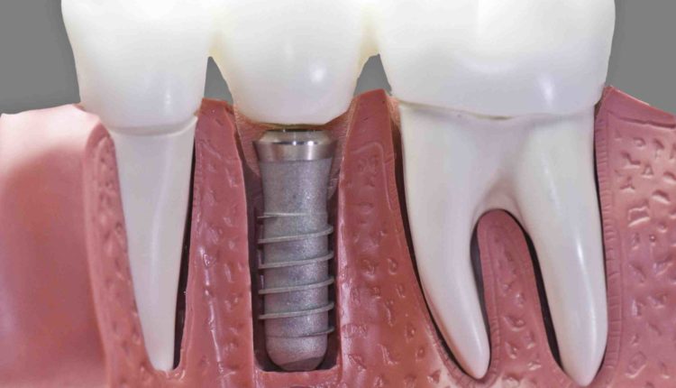 How dangerous are titanium dental implants