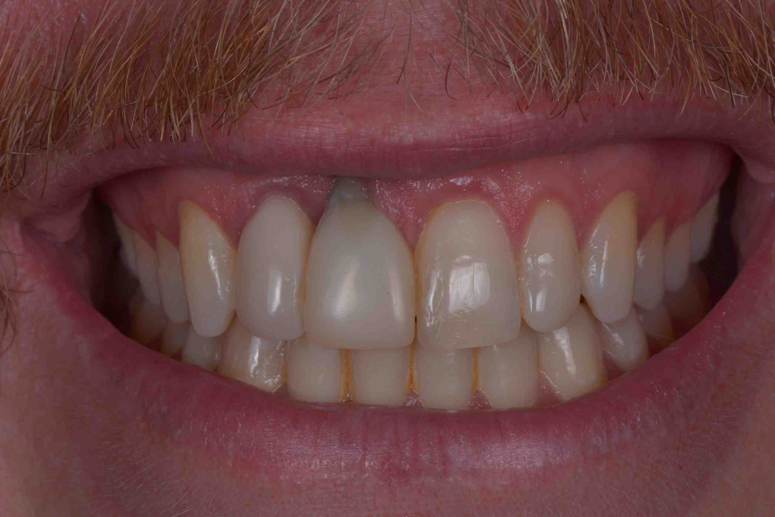 How do I keep my dental implants from failing?