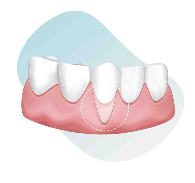 How do I know if my dental implant is failing?