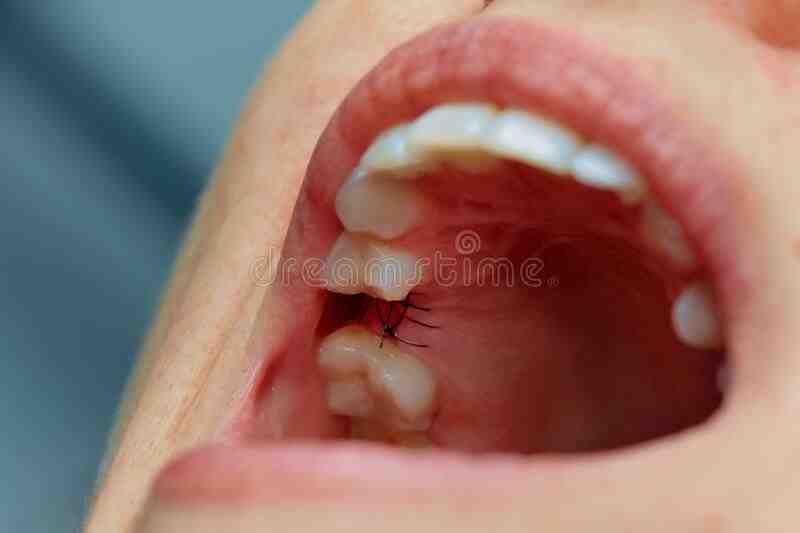 How do I know if my dental implant is healing correctly?