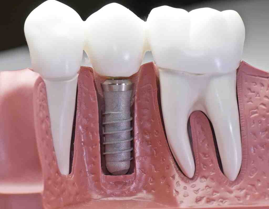 How do I know if my dental implant is healing correctly?