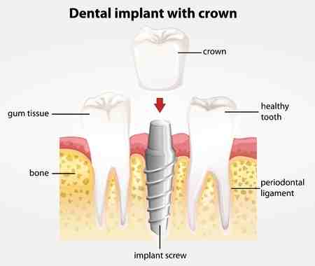 How do I know if my implant crown is loose?