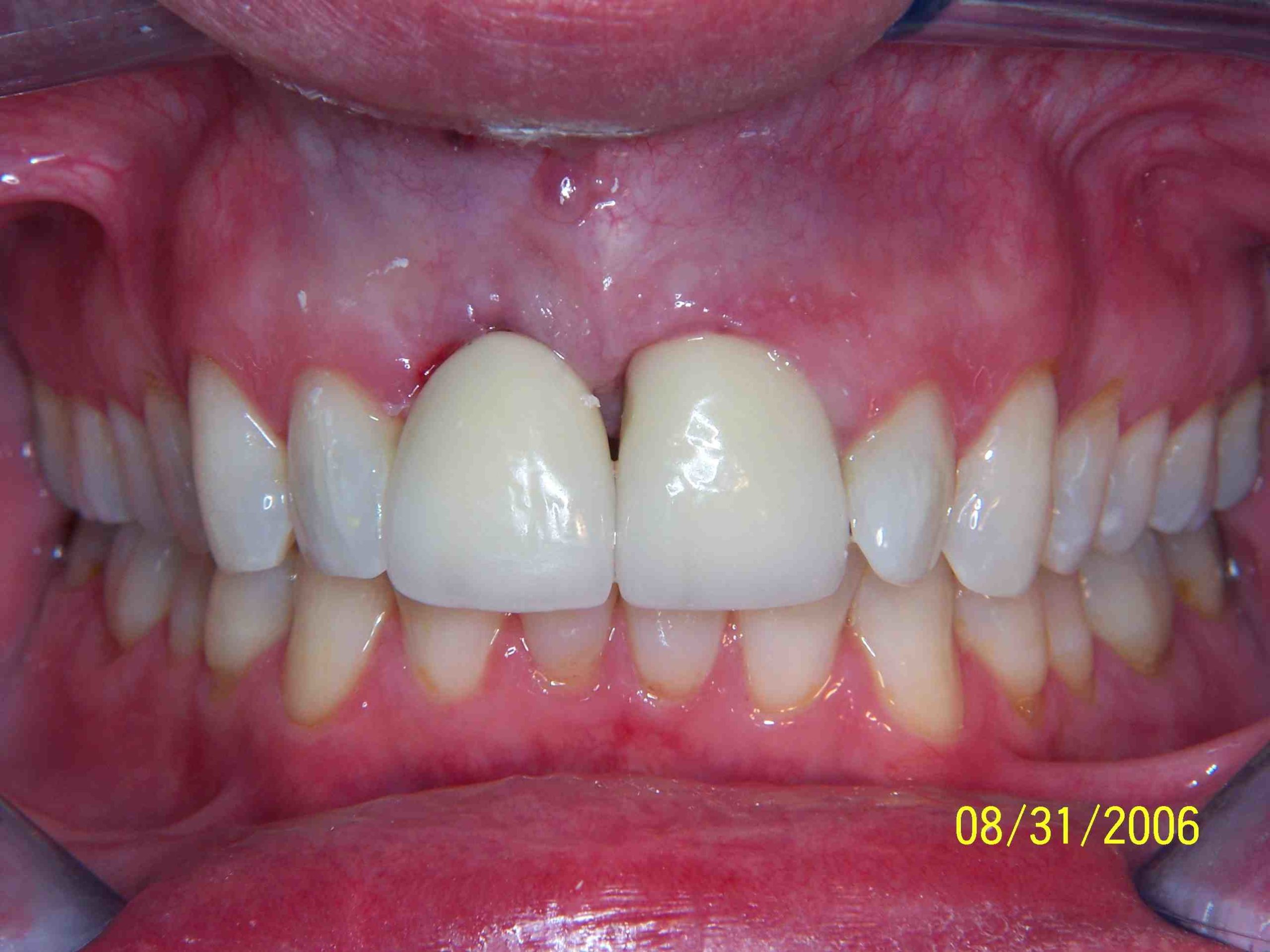 How do I make my gums grow back?
