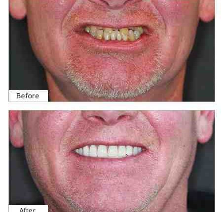 How do i find a good dental implants dentist?