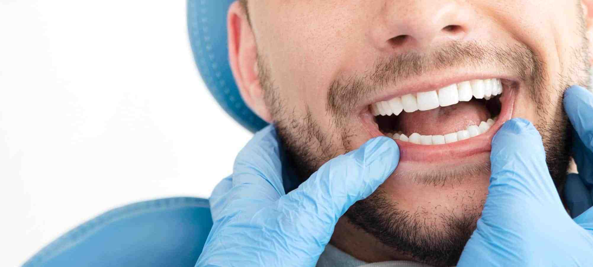 How do lasers fill cavities?