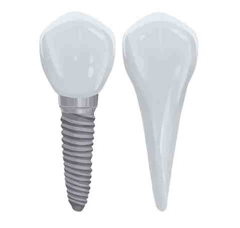 How do you clean mini dental implants?