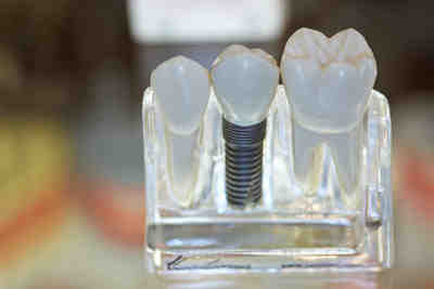 How do you clean under dental implants?