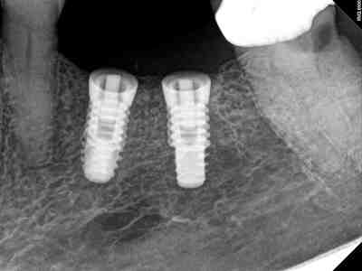 How do you clean under implants?