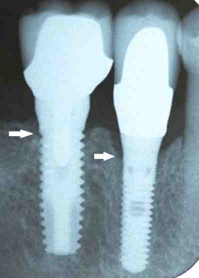 How do you clean your mouth after the implant?