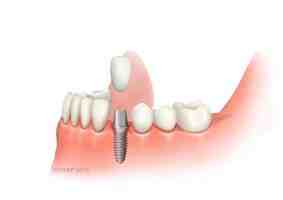 How do you feel after a dental implant?