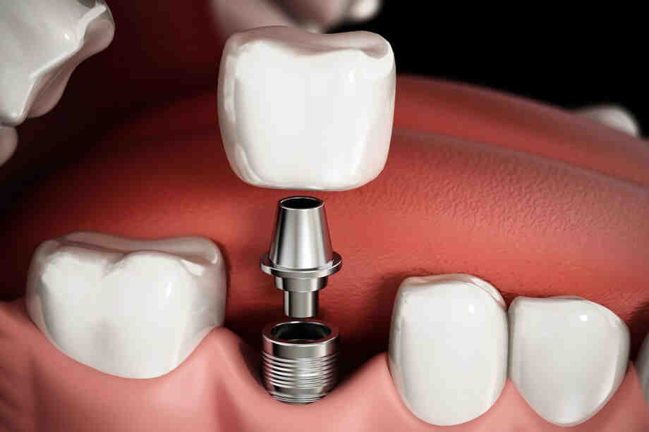 How do you fix a loose dental bridge at home?