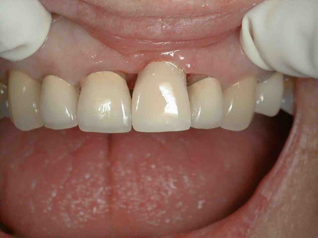 How do you fix a receding gum implant?