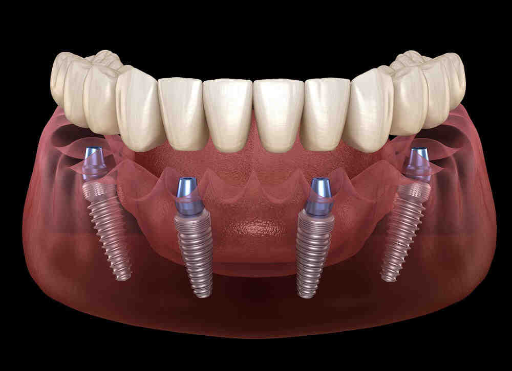 How do you floss under implants?