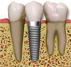 How do you know when an implant fails?