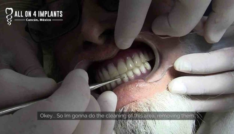 How do you polish dental implants