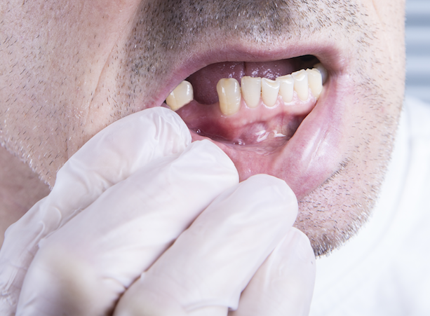 How do you prevent bone loss with implants?