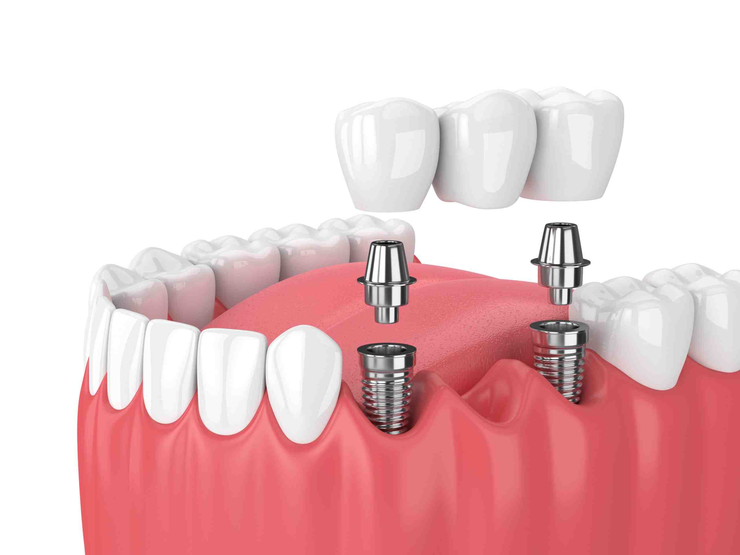 How do you prove medical necessity for dental implants?