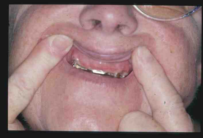 How do you test for metal allergy?