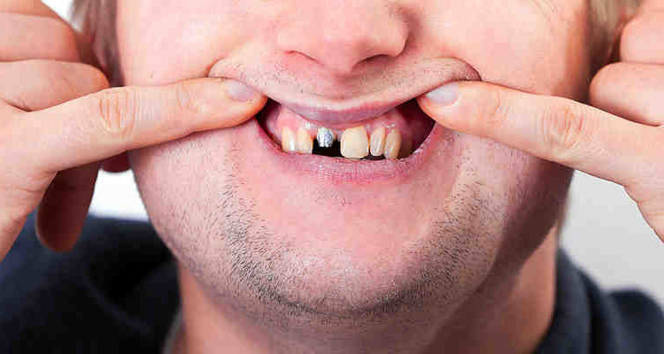 How does a dental implant fail