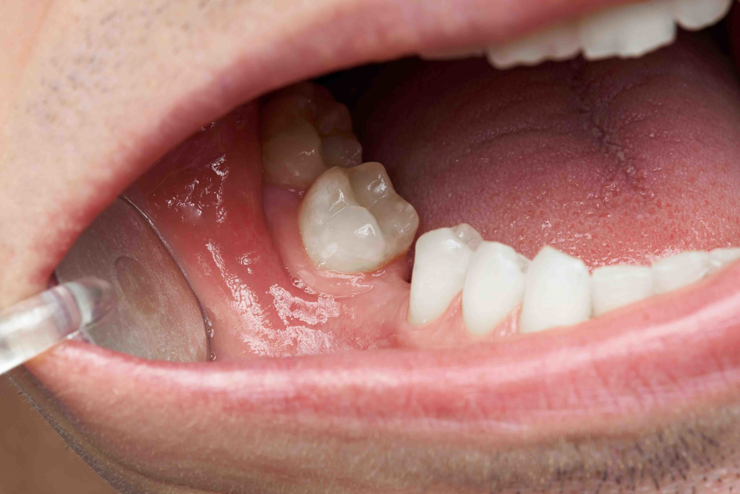 How does a single tooth denture stay in?