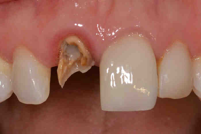 How does bone heal around an implant?