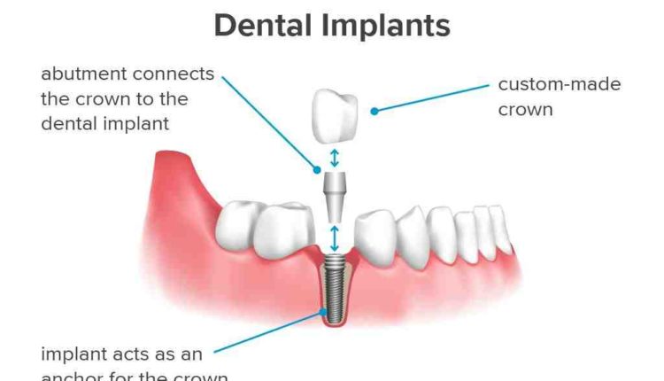 How effective are dental implants