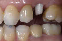How is a dental abutment placed?