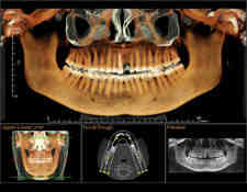 How is implant attached to abutment?