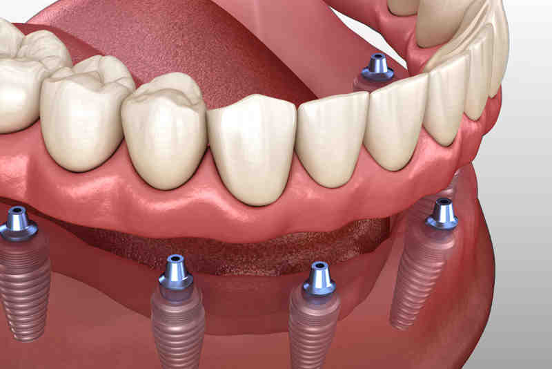 How is the abutment attached to implant?