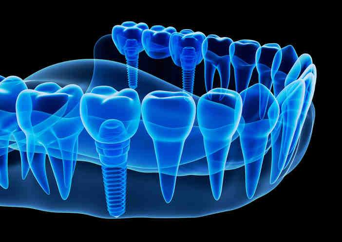 How long after dental implant can I use a straw?