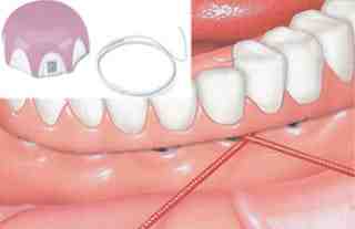 How long after implant can you get a crown?