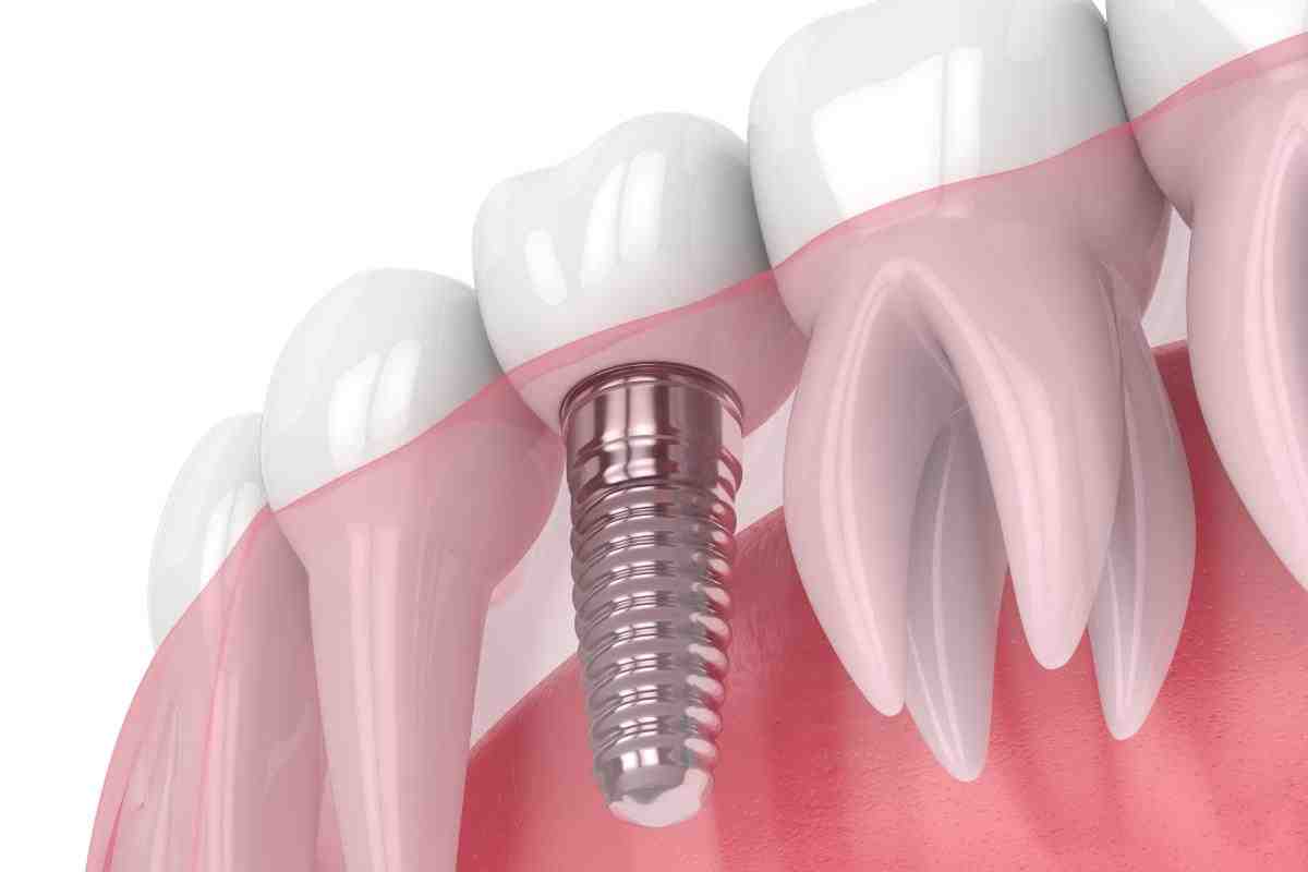 How long after implant can you get crown?