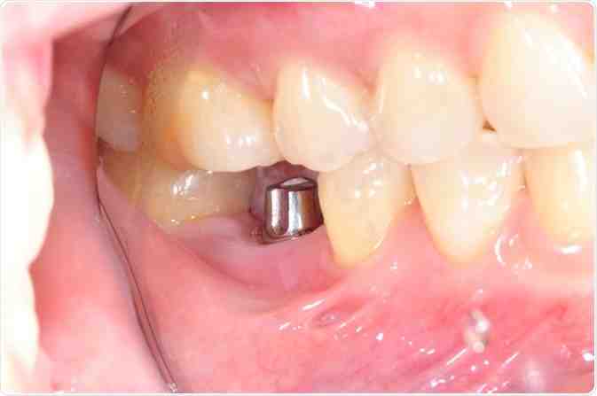 How long are gums sore after implant surgery?