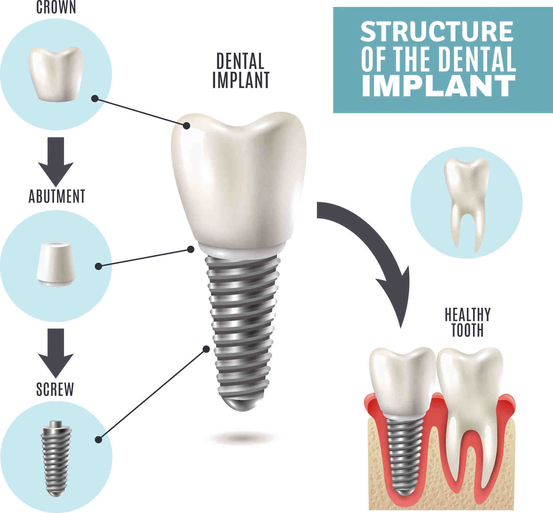 How long are gums sore after implant surgery?